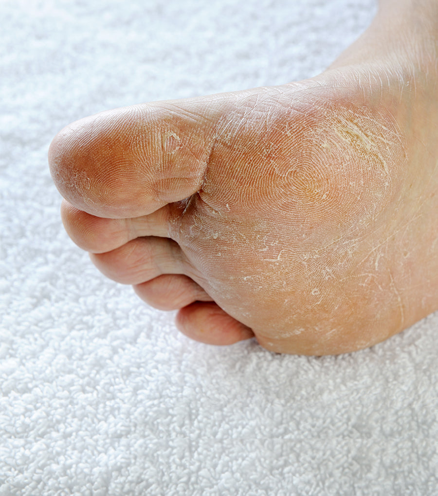 Why does the dry skin on my feet never improve?